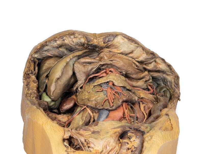 Abdomen m. inguinalhernie - eAnatomi