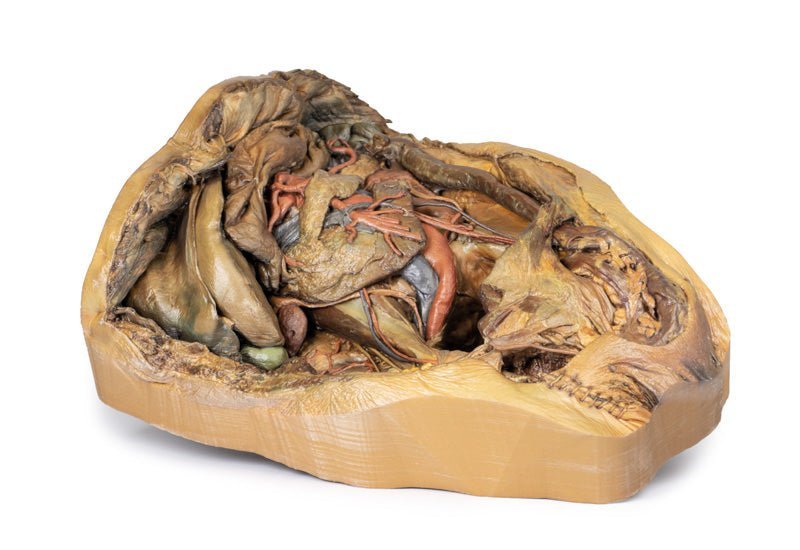 Abdomen m. inguinalhernie - eAnatomi