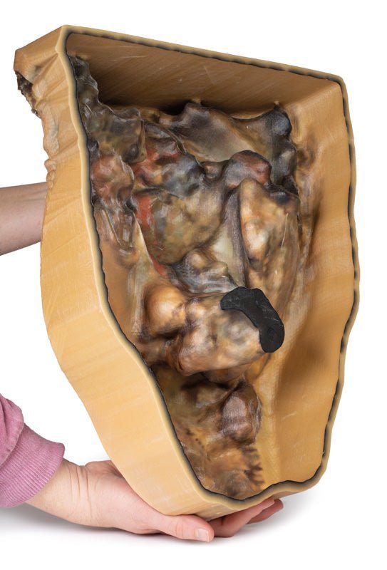 Abdomen m. inguinalhernie - eAnatomi