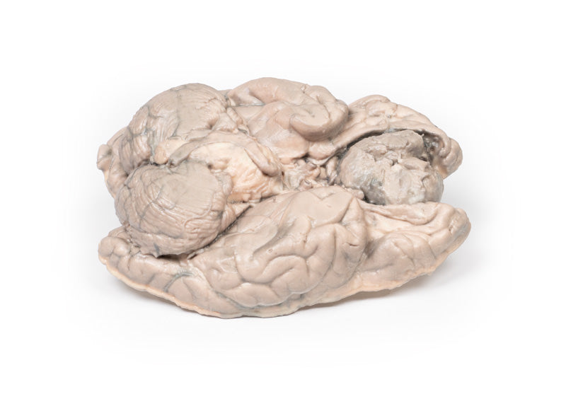 Meningiom