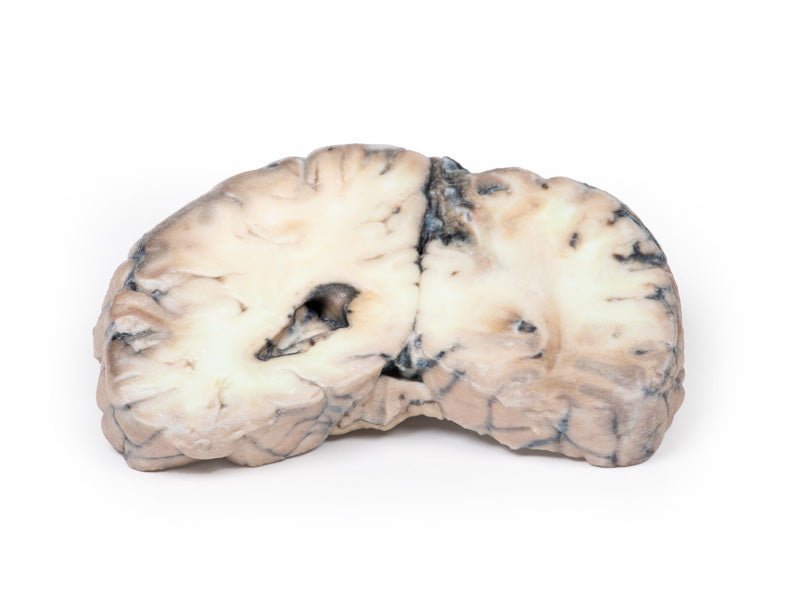 Cerebral arteriovenøs malformation (AVM) - eAnatomi