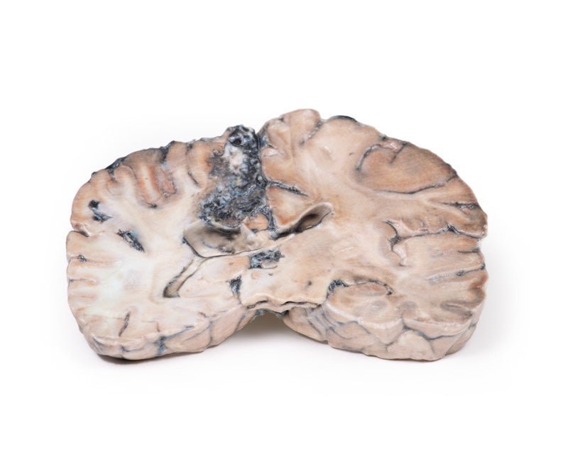 Cerebral arteriovenøs malformation (AVM) - eAnatomi