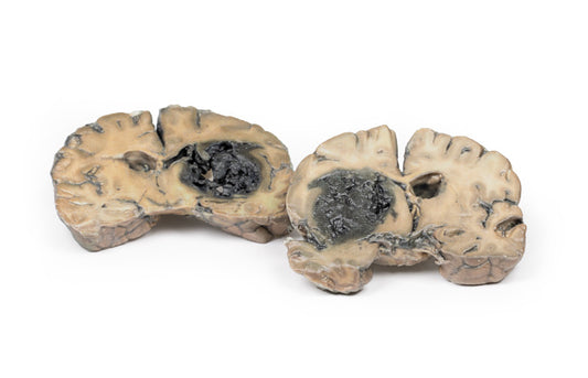 Intracerebral blødning