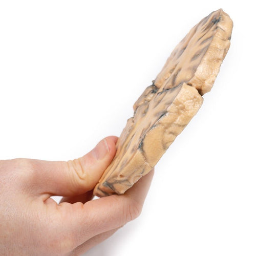 Astrocytom - eAnatomi