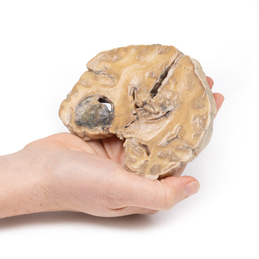 Glioblastoma multiforme