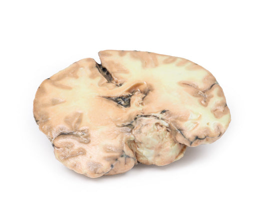 Glioblastoma multiforme