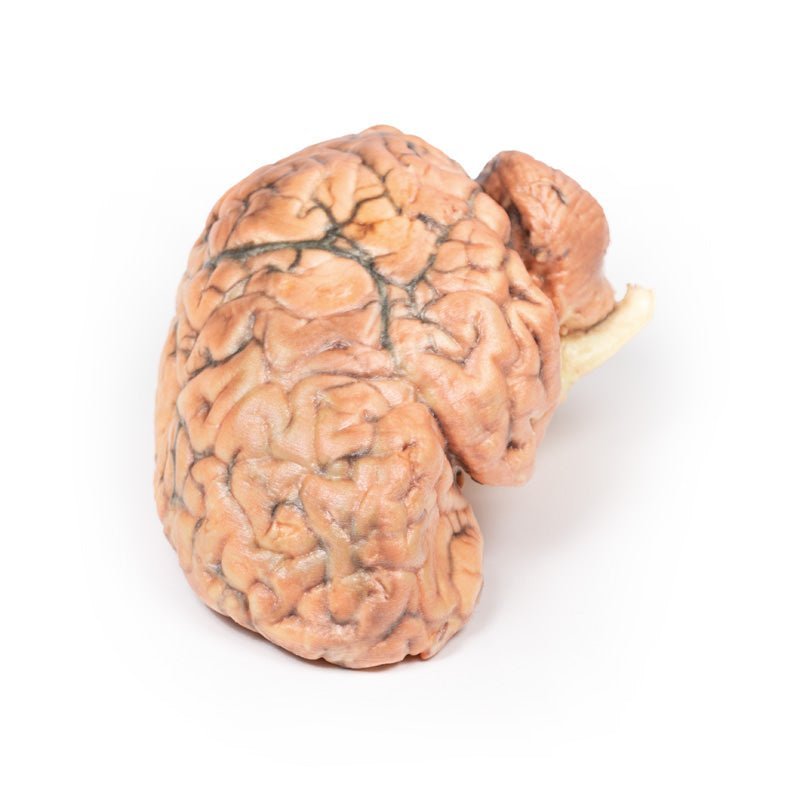 Kraniofaryngeom (Rathkes poche - tumor) - eAnatomi