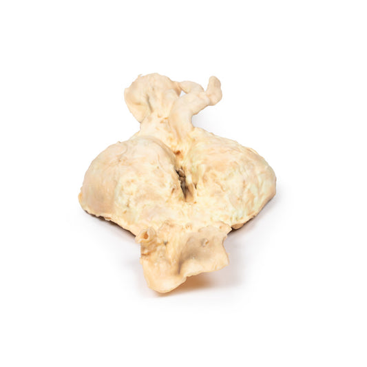 Abdominal aortaaneurisme