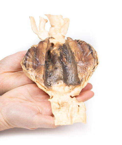 Abdominal aortaaneurisme - eAnatomi