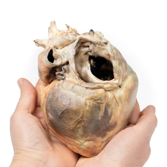 Atrial septal defekt