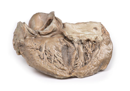 Bikuspidal aortaklap