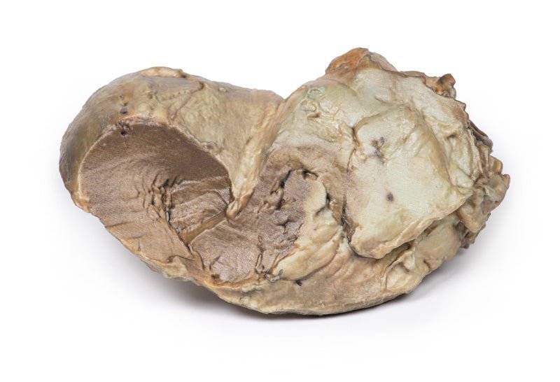 Bicuspid aortaklap - eAnatomi
