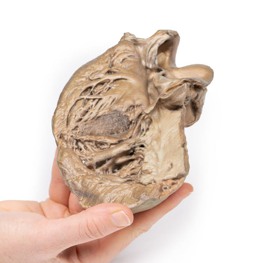 Bikuspidal aortaklap