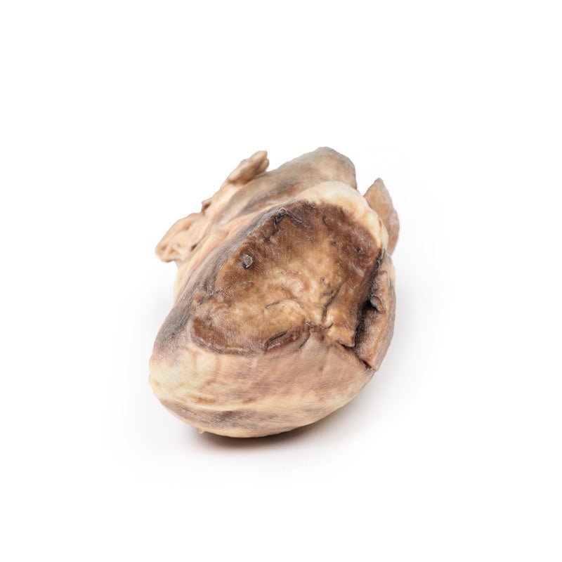 Kongenit pulmonalstenose - eAnatomi