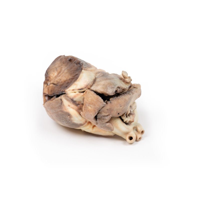 Kongenit pulmonalstenose - eAnatomi