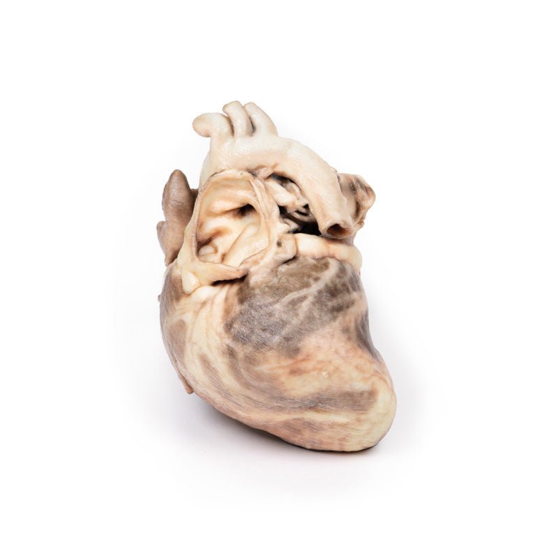 Kongenit pulmonalstenose - eAnatomi