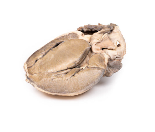 Hypertrofisk subaortastenose