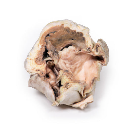 Forkalket aortaklapstenose Bikuspidal aortaklap