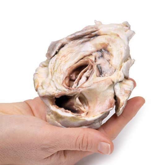 Forkalket aortaklapstenose Bikuspidal aortaklap