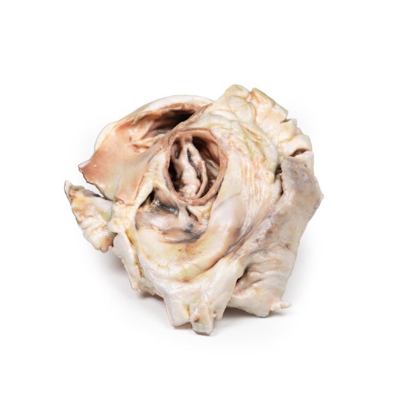 Forkalket aortastenose m. bicuspid aortaklap - eAnatomi