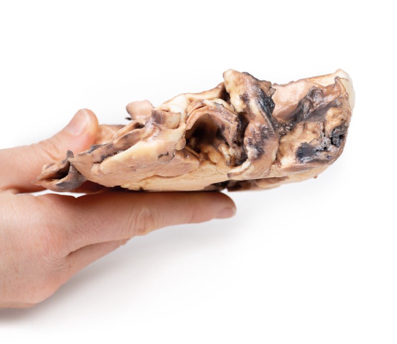 Reumatisk endocarditis - eAnatomi