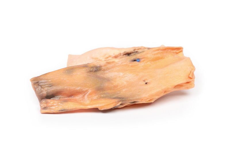 Traumatisk esophageal - aorta fistel - eAnatomi