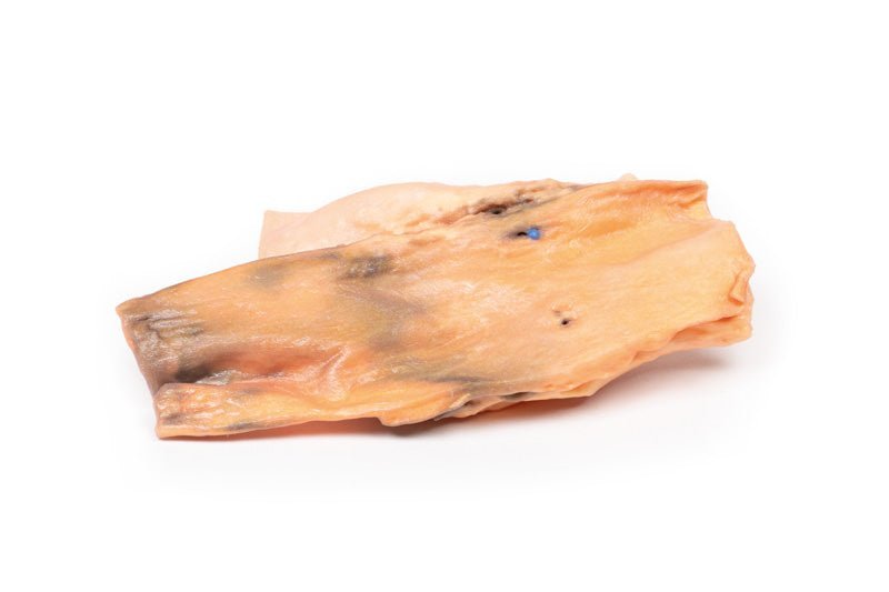 Traumatisk oesophago - aorta fistel - eAnatomi