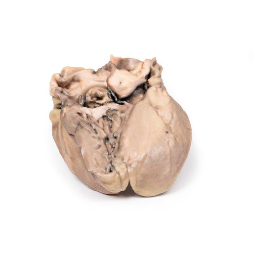 Akut bakteriel endokarditis - eAnatomi