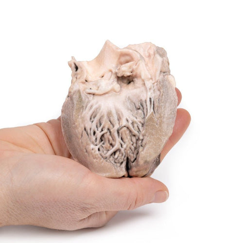 Akut bakteriel endokarditis - eAnatomi