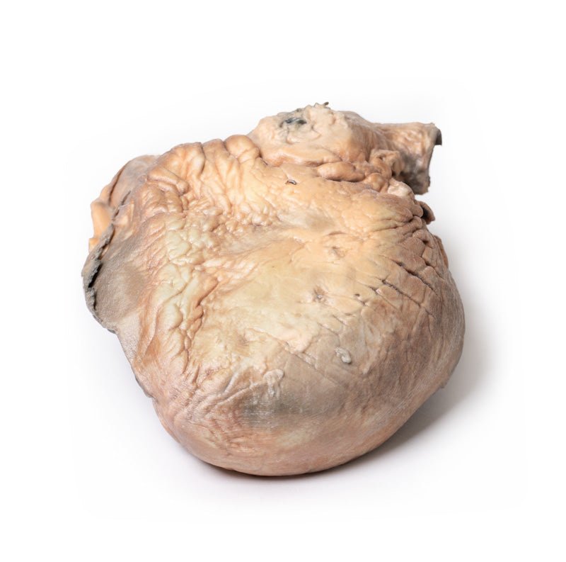 Brudt thorax aortaaneurisme - eAnatomi