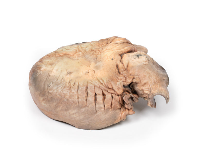 Brudt thorax aortaaneurisme