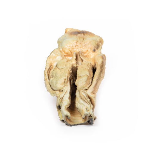Carcinom i Larynx