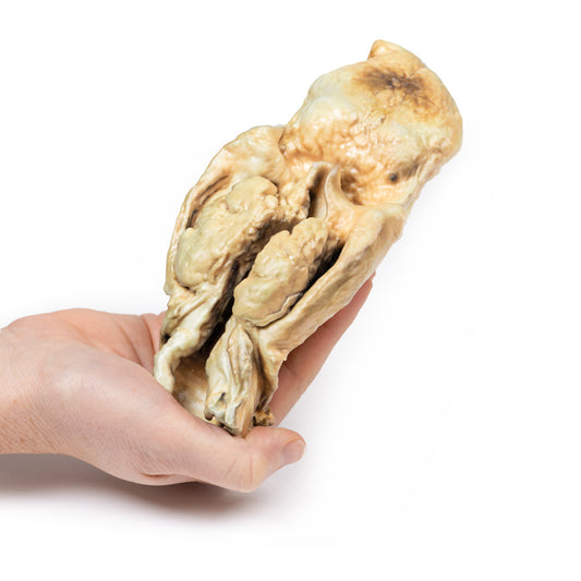 Carcinom i Larynx