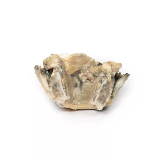 Carcinom i Larynx