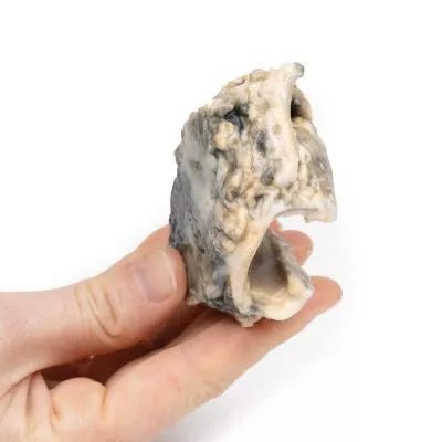 Carcinom i Larynx - eAnatomi
