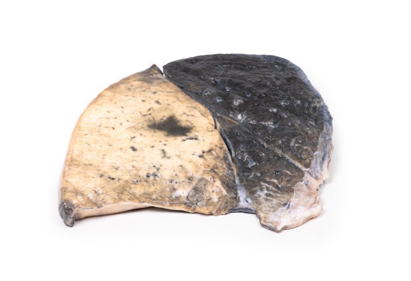 Lobær pneumoni - eAnatomi