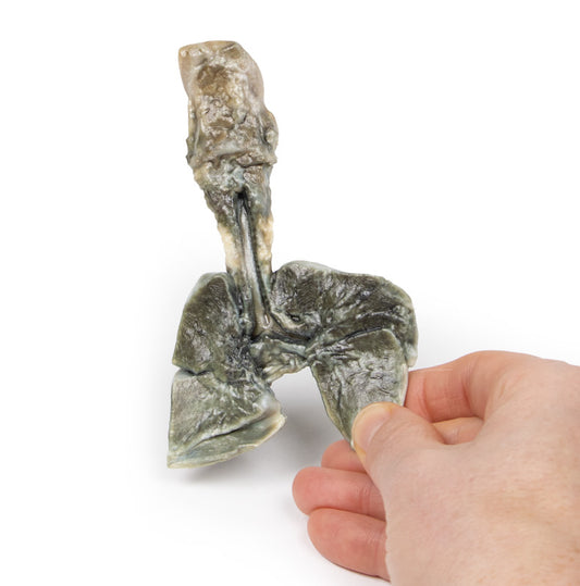 Tracheoesophageal fistel og esophagus atresia