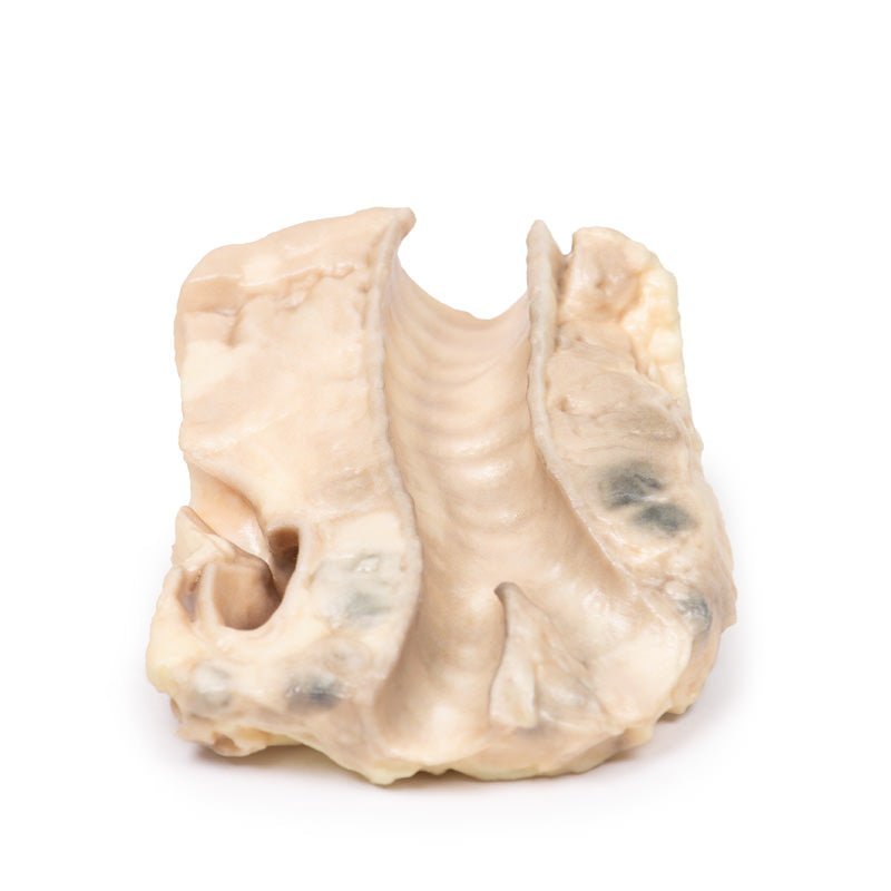 Trachea m. Hodgkins lymfom - eAnatomi