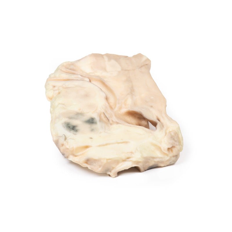 Luftrør – Hodgkins lymfom - eAnatomi