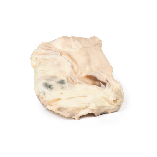 Luftrør – Hodgkins lymfom