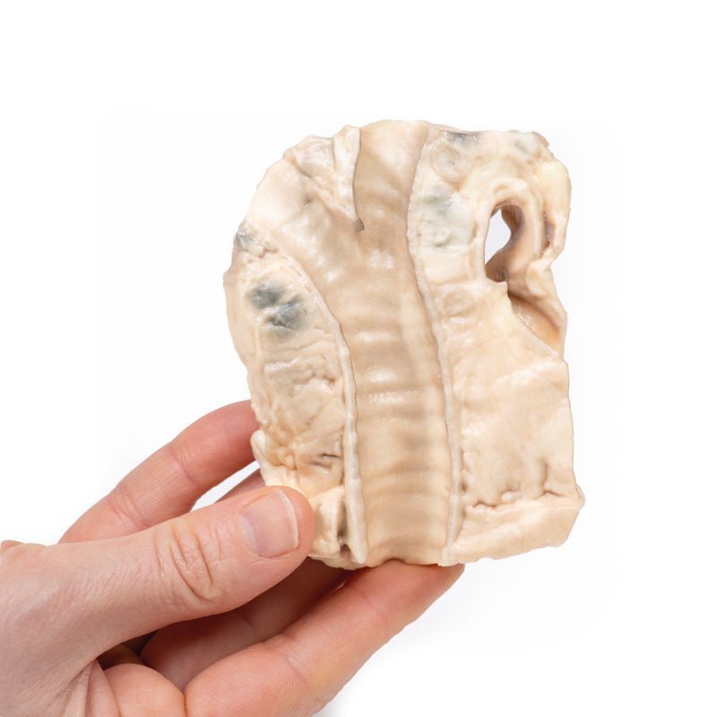 Trachea m. Hodgkins lymfom - eAnatomi