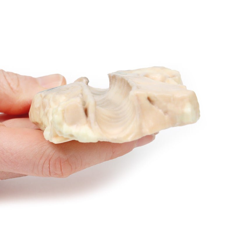 Trachea m. Hodgkins lymfom - eAnatomi