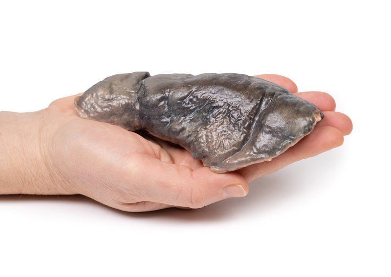 Lunge m. cystisk fibrose - eAnatomi
