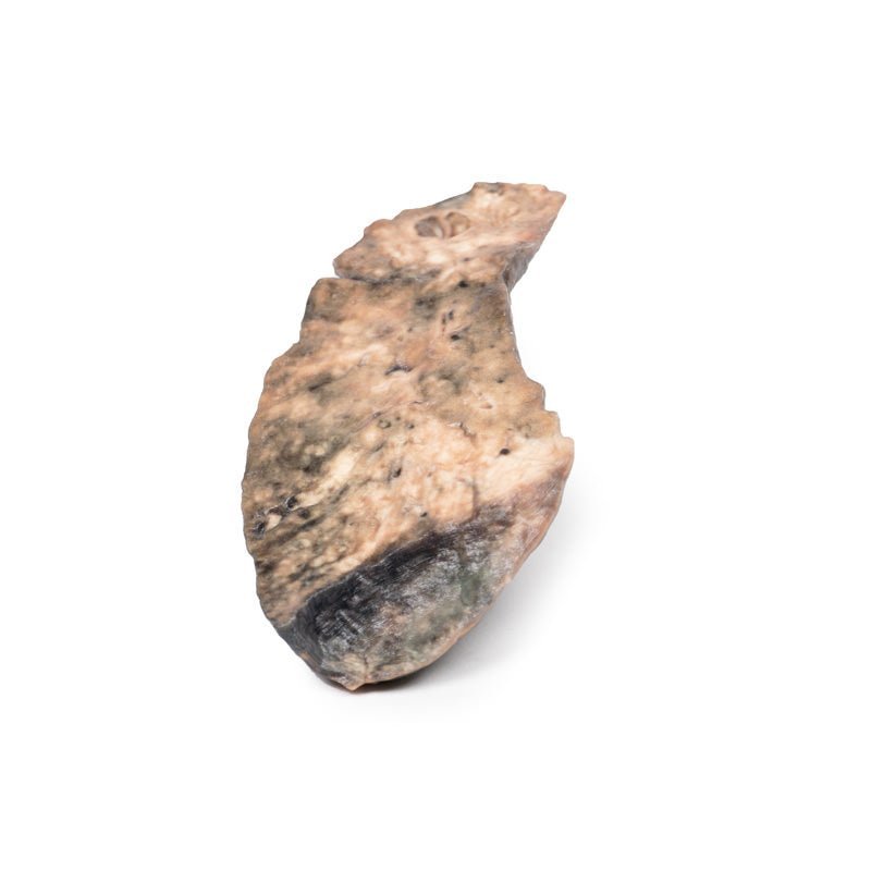 Lunge m. cystisk fibrose - eAnatomi