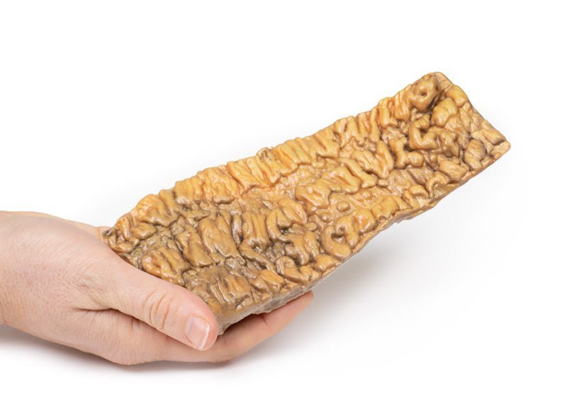 Colitis ulcerosa - eAnatomi