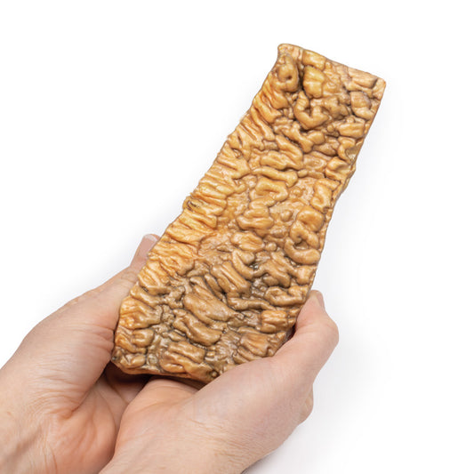 Colitis ulcerosa