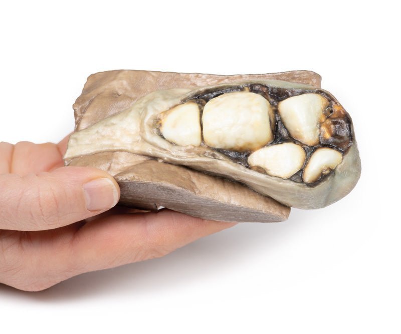 Cholelithiasis (galdesten) - eAnatomi