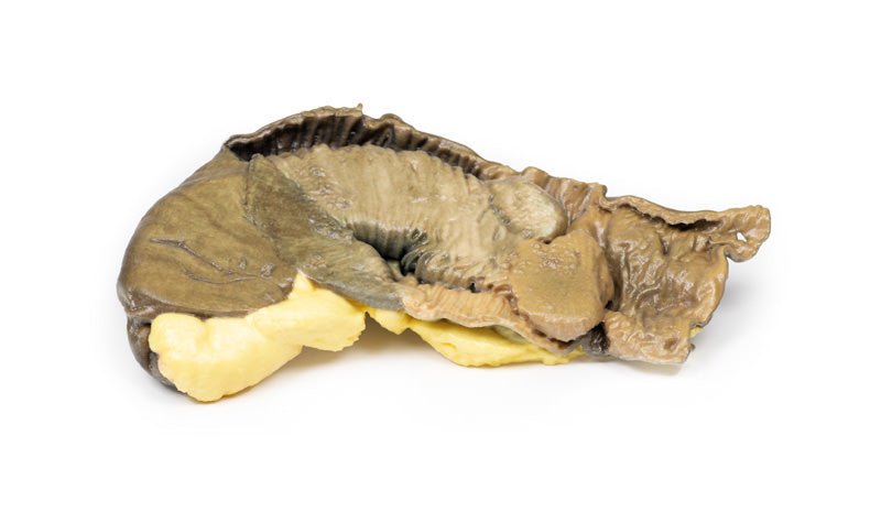 Intussusception af tyndtarmen på grund af metastatisk tumor - eAnatomi