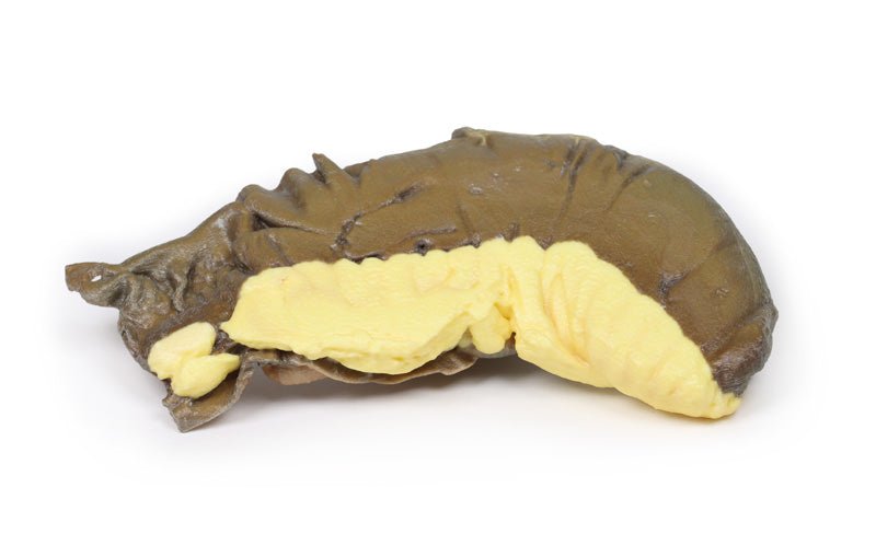 Intussusception af tyndtarmen på grund af metastatisk tumor - eAnatomi