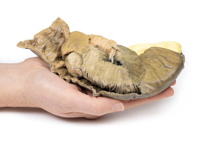 Tyndtarmsinvagination pga. metastatisk tumor - eAnatomi